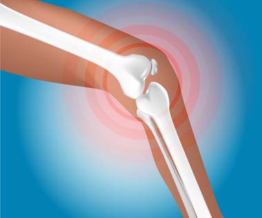 Artroscopia de Rodilla (Lesiones de Menisco) en Barcelona